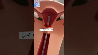 فيديو روعة لتوضيح كيفية تركيب اللولب فى الرحم لمنع الحمل دندنها