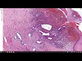 Endometriosis - Histopathology