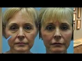 Virginia Beach plastic surgeon Dr Thomas Hubbard explains how fat grafting can lift the aging cheek