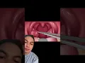 Download Lagu Selama kamu punya BATU AMANDEL meskipun pakai obat kumur 1Liter per hari ga akan bisa menutupi BAU