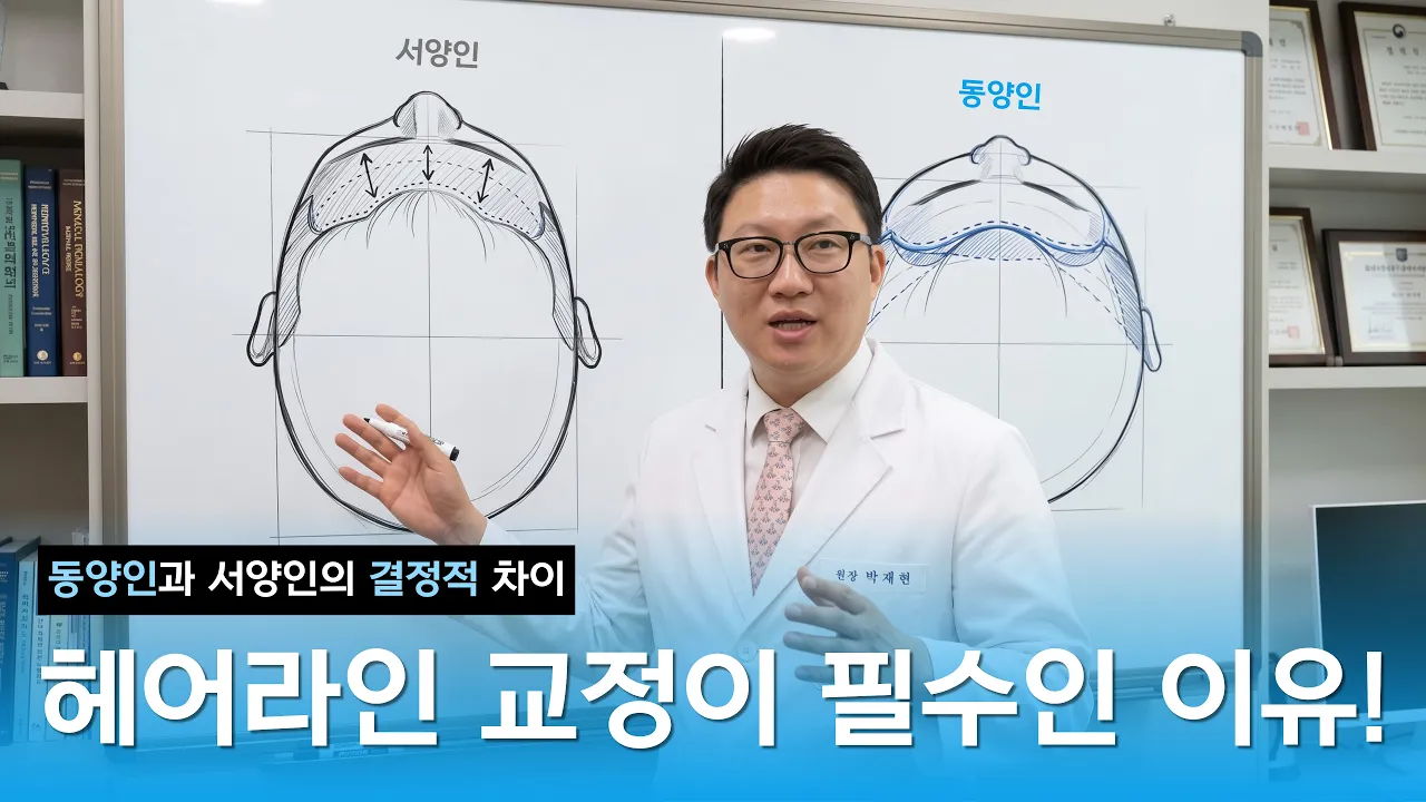 동양인과 서양인의 결정적 차이! 한국인에게 헤어라인 교정이 필수인 이유