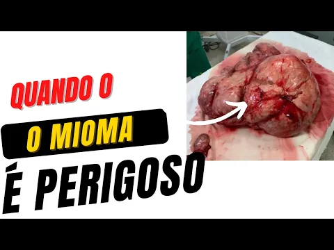 Download MP3 MIOMA NO ÚTERO: QUANDO SE PREOCUPAR?