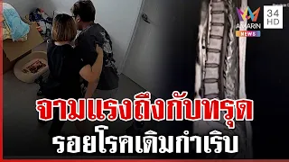 อุทาหรณ์! หนุ่มป่วยหมอนรองกระดูก จามทีเดียวถึงกับทรุด | ทุบโต๊ะข่าว | 22/09/69