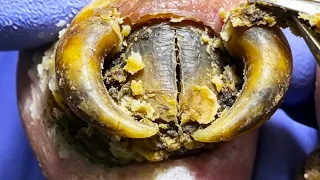 WOW~Thick Shells On Toenails, Pulled Out Instantly【Xue Yidao】
