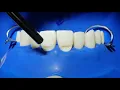 Class V tooth colored restorations