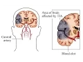 Download Lagu Transient Ischemic Attack (TIA)