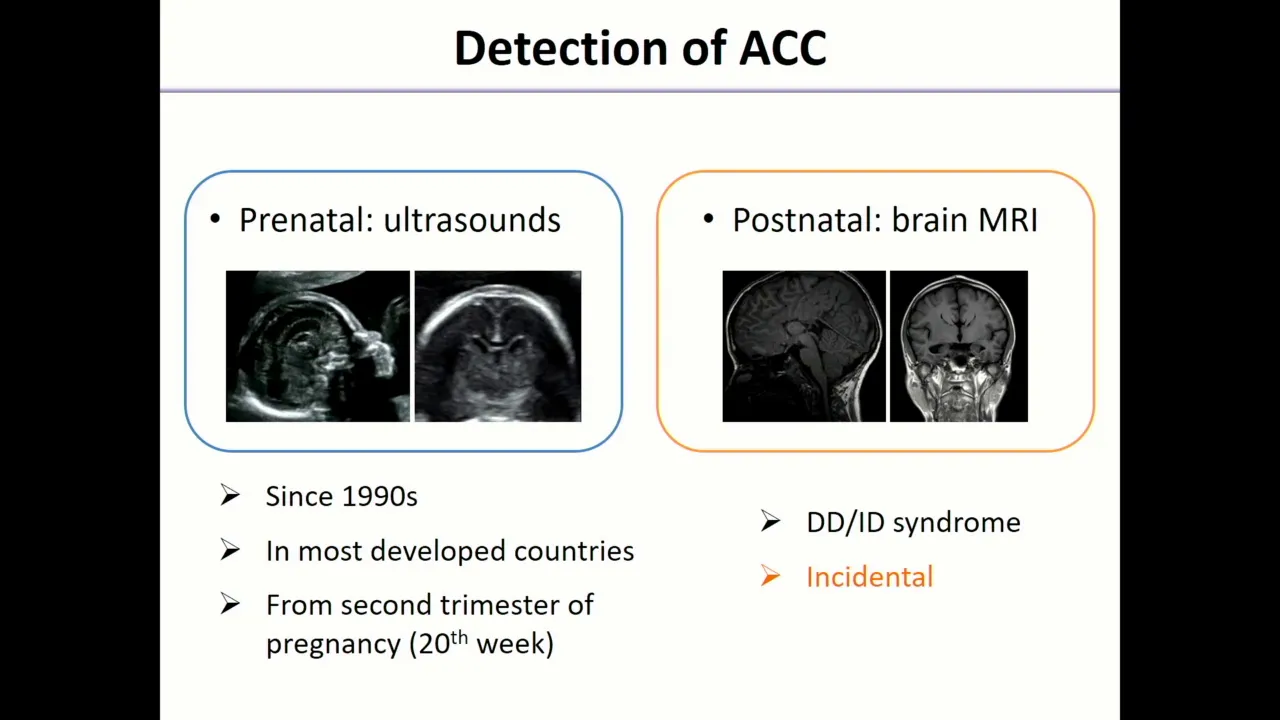 E13.1 Defects of the corpus callosum
