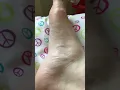 BFS Right foot twitching