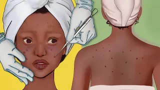 Spa Treatment ASMR animation // Back Pimple Removal// Stop Motion Animation
