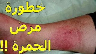 مرض الحمرة الأسباب العلاج 