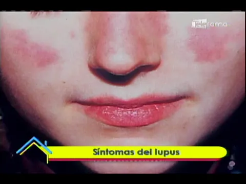 Síntomas del lupus