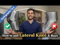 The Lateral Knee X-Ray Alignment Rule