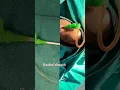Download Lagu angiography 🫀 | angio heart problems 💊| cardiology 🫀#heart #angiogram #shotsfeed @Utype197 #viral