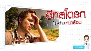 ฮีสโตรกคืออะไร และทำไมจึงถือว่าเป็นภาวะฉุกเฉินทางการแพทย์