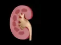 Urology Month Am I Passing a Kidney Stone