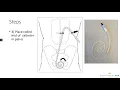 Laparoscopic Peritoneal Dialysis Catheter Placement - for patients