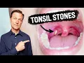 What CAUSES Tonsil Stones and How to Prevent Them