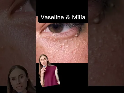 Vaseline Causes Milia? FALSE!