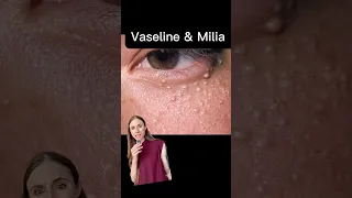 Vaseline Causes Milia? FALSE!