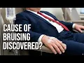 Lagu REAL DOCTOR examines Trump's NEW BRUISING (is it IV infusions for dementia?)