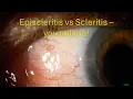 Download Lagu 0100: Episcleritis vs Scleritis - you tell me!