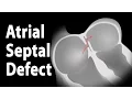 Lagu Atrial Septal Defect (ASD), Animation.