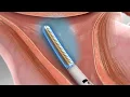 Endometrial Cryoablation 3D Animation