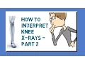 How to interpret knee X-rays - Part 2