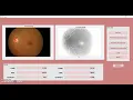Image Enhancement for Diabetic Retinopathy Disease