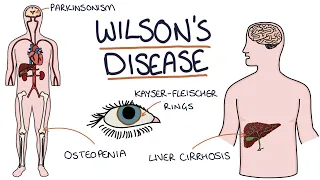 understanding wilsons disease