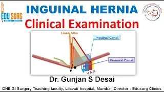 clinical examination of inguinal hernia step by step guide
