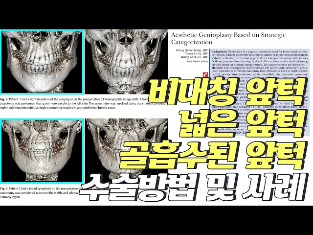 [논문 리뷰] 미용적인 턱끝수술의 단계적 접근