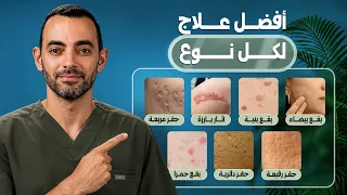 العلاج الفعّال لجميع أنواع الآثار