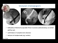 Occlusion Cholangiogram