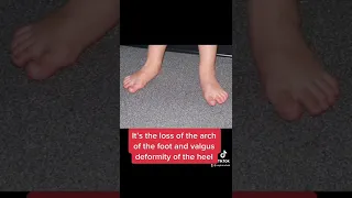 Pes Planus Or Flat Feet 