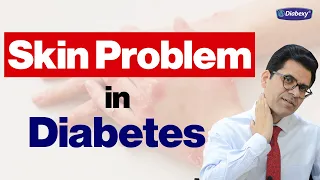 मस्से या Skin Tags आपकी Skin पर क्यों हो जाते हैं | Skin Problems Among Diabetics | Diabexy EDU 29