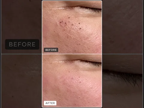 Extractor vs. Fingers? Why I love the comedone extractor #drpimplepopper #popaholics