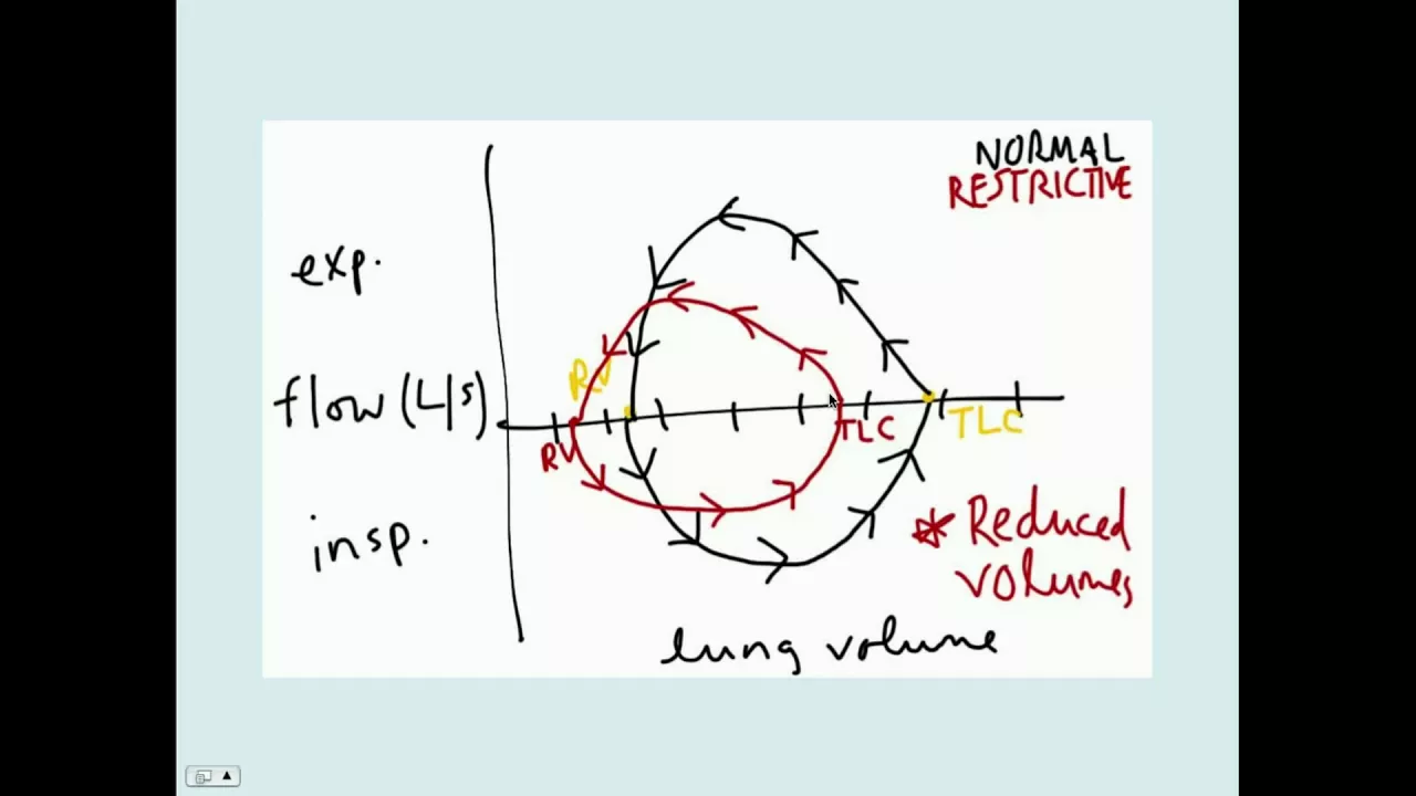Interstitial Lung Disease - CRASH! Medical Review Series