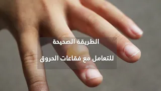 كيفية التعامل مع فقاعات الحروق وهل نزيلها ومتى 