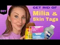 Get Rid of Milia Skin Tags At Home