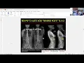 What Is the Target for Optimal Sagittal Alignment and How Do We Achieve It Lawrence G Lenke MD