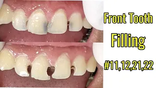 Download Front tooth filling #11,12,21,22 MP3