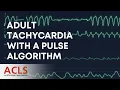 Adult Tachycardia With a Pulse Algorithm Explained ACLS Certification Association