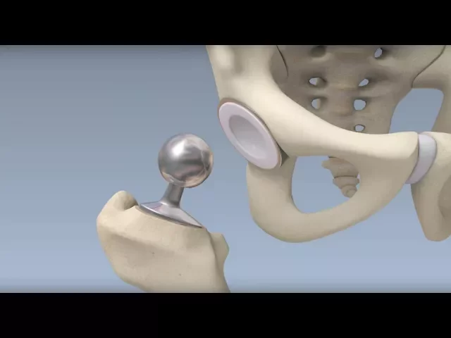 Hip Surgery Overview - Mayo Clinic