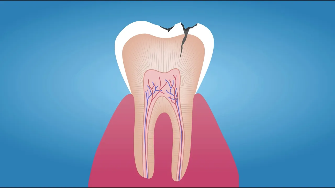Outline Video The Tooth Decay Process: How to Reverse It and Avoid a Cavity. Tips for Parents.