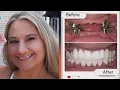 Gypsy Rose Blanchard Shows Off DRASTIC Smile Makeover