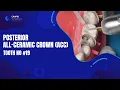 Posterior All-Ceramic Crown ACC on tooth no Full Course on Link Below