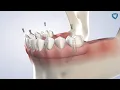 Full-Arch Restoration at Columbia Basin Oral Maxillofacial Surgeons
