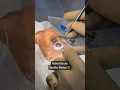 Download Lagu Say Goodbye to Glasses!!! #eyecare #eyehealth #eyesurgery #smile #Contoura #icl #lasik #laser