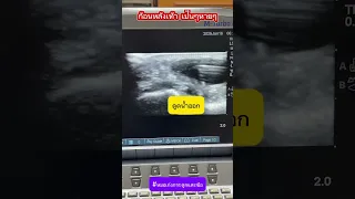 ก้อนที่บริเวณหลังเท้าด้านฝ่าเท้าที่มีมาประมาณ 3 เดือน เป็นอะไร และเกิดจากสาเหตุใด